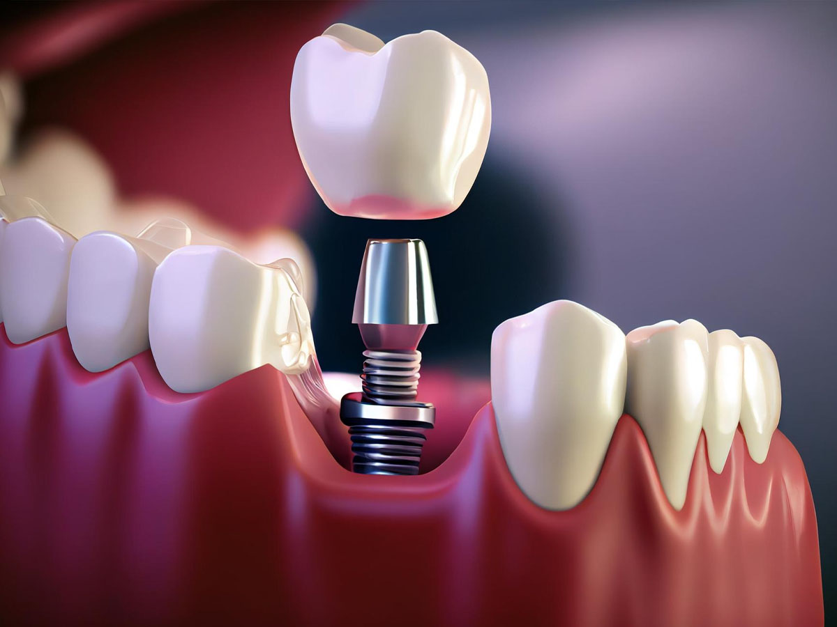 Preparing for Your Implants
