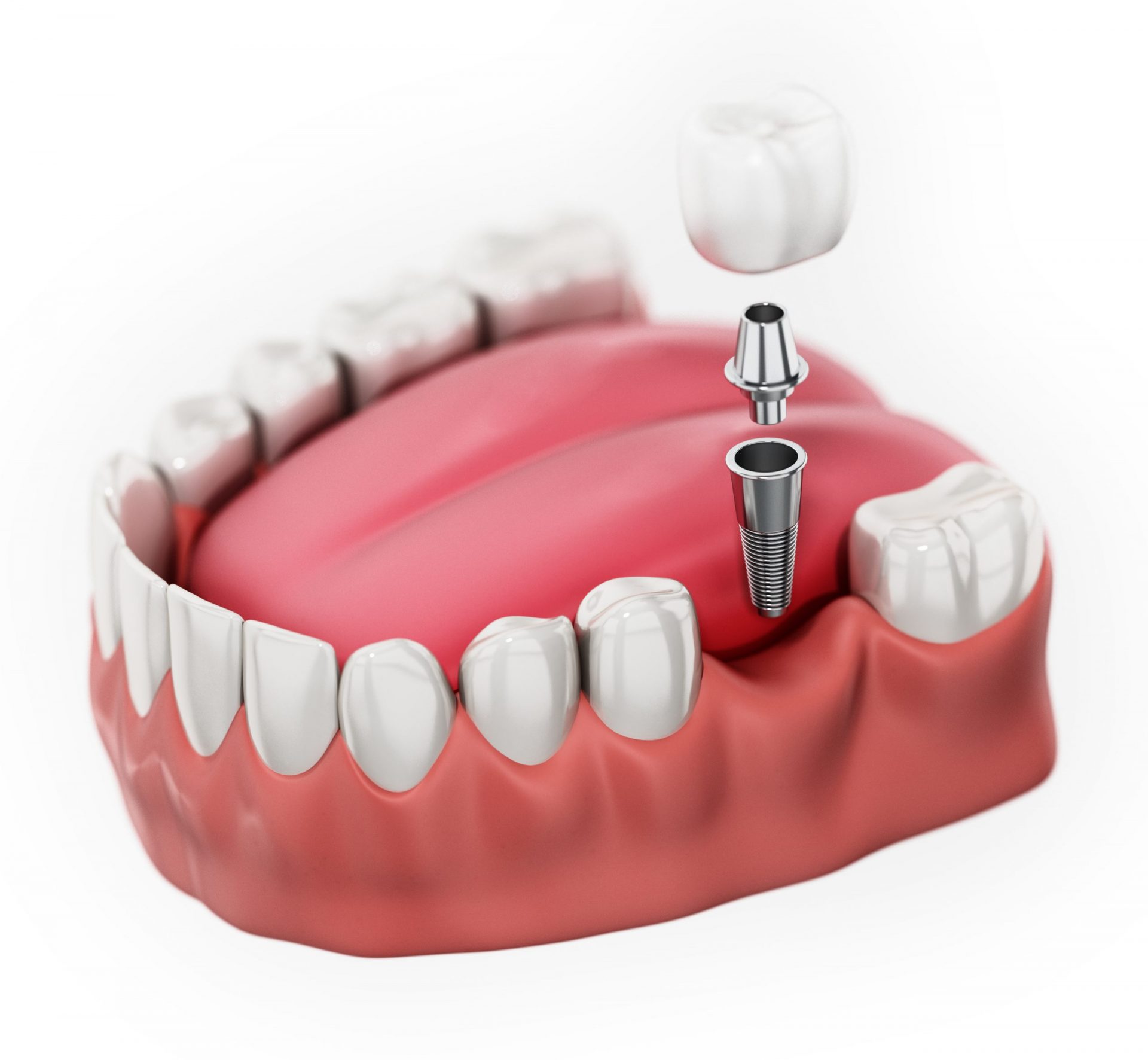 Choosing the Right Dentist