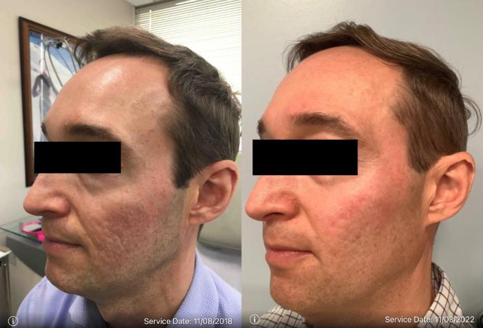 The Science Behind Microneedling