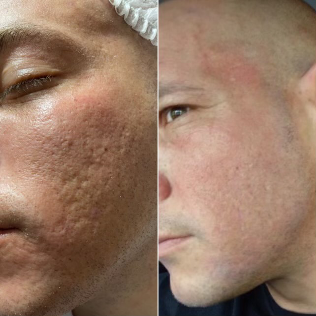 What to Expect During Microneedling