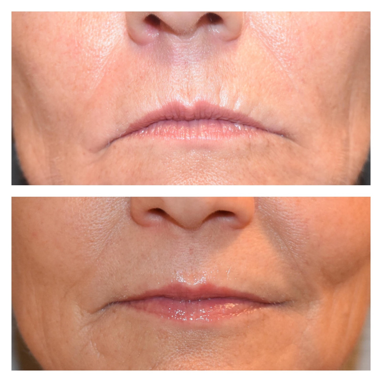 Enhancing Results With Microneedling Aftercare