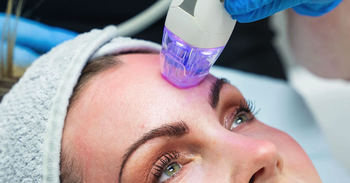 Post-Care Tips for Microneedling Recovery