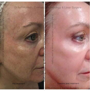 Minimizing Pore Size With Laser Treatments