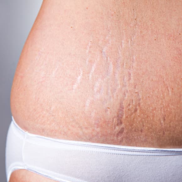 Laser Skin Resurfacing