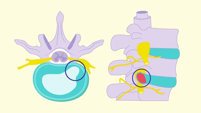 Neurovertebral Decompression Provides Quick Pain Relief